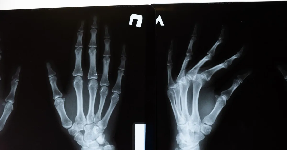 X-ray opaque PEEK needs imaging checks: a radiograph of two hands showing bone structure on a black background
